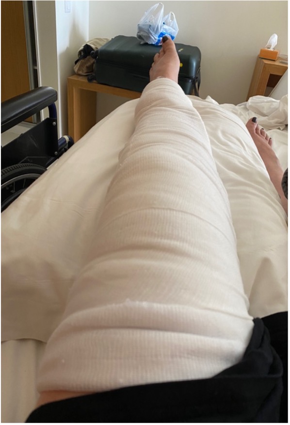 Leg in bandage
