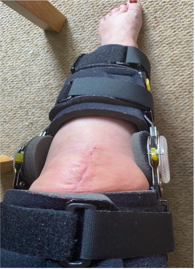 Leg in brace